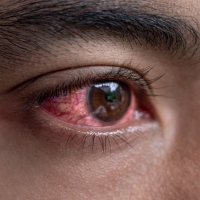 ¿Cómo puede el Coronaviros afectar a sus ojos?